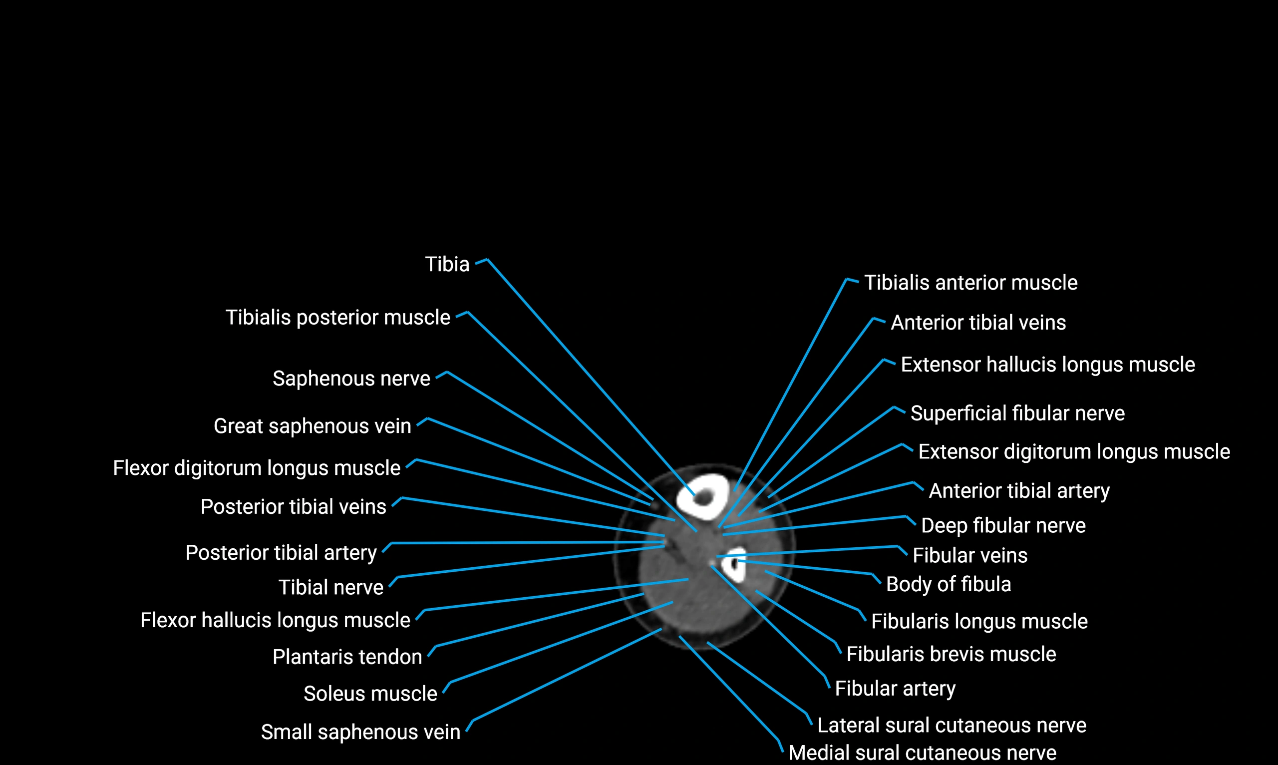 CT lower limb axial cross sectional anatomy labelled image 140 (2).webp